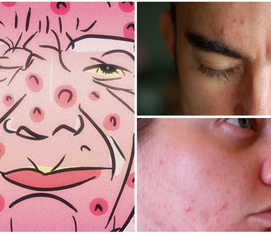 ¿Eres adulto y tienes acné? ¡Te explicamos porqué! ¿Eres adulto y tienes acné? ¡Te explicamos porqué!