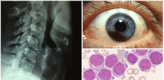 13 datos sobre el cáncer que quizá ignorabas
