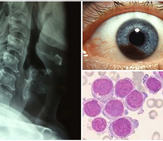 13 datos sobre el cáncer que quizá ignorabas