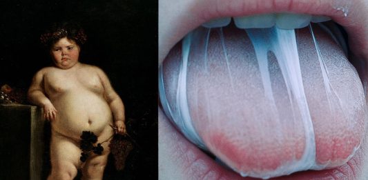 El síndrome de Prader-Willi "comer sin parar hasta morir"