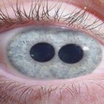 ¿Es posible tener dos pupilas?