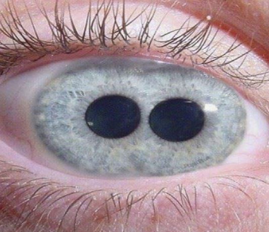 ¿Es posible tener dos pupilas?