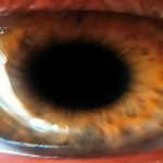 ¿Es posible tener dos pupilas?