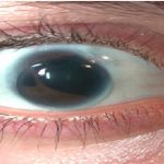 ¿Es posible tener dos pupilas?