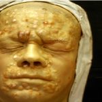 Una antigua epidemia encubierta: la sífilis