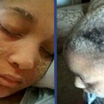 El fenómeno de la mujer a la que crecen uñas en lugar de pelo