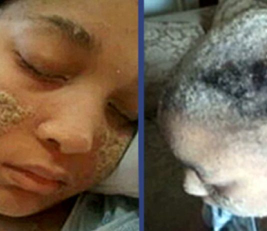 El fenómeno de la mujer a la que crecen uñas en lugar de pelo El fenómeno de la mujer a la que crecen uñas en lugar de pelo