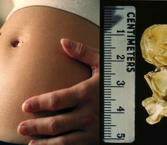 El increíble fenómeno de los bebés de piedra - nunca abandonan a sus madres