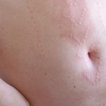 Dermatografismo, cuando puedes escribir en tu piel con sólo tocarla
