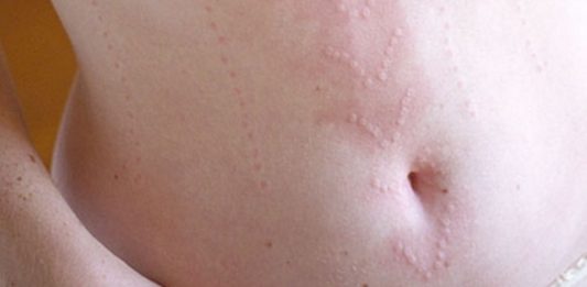 Dermatografismo, cuando puedes escribir en tu piel con sólo tocarla