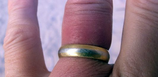 5 Trucos para sacar un anillo atascado en un dedo