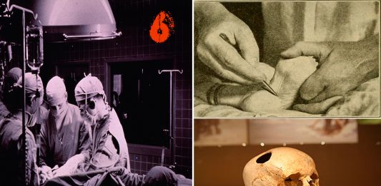 6 intervenciones médicas brutales que podrían practicarte hoy