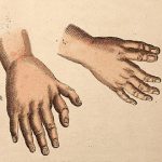 Extra fingers – polydactyly illustration