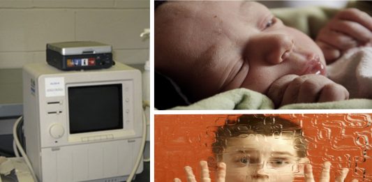 ¿Se puede predecir el autismo con ultrasonido en niños recién nacidos?