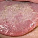 5 síndromes súper raros que puedes sufrir