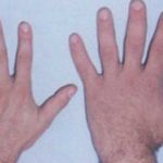 Comparación de la mano izquierda de una persona sin acromegalia (izq.) y de una persona que la padece (der.)
