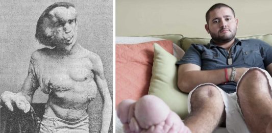 Síndrome de Proteus ¡una de las enfermedades más raras del mundo!