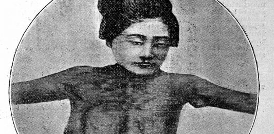 Polimastia: tener un seno de más en el cuerpo es posible Polimastia: tener un seno de más en el cuerpo es posible