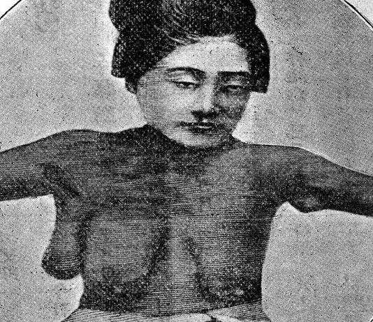 Polimastia: tener un seno de más en el cuerpo es posible Polimastia: tener un seno de más en el cuerpo es posible