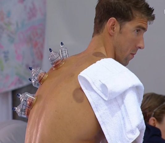 Cupping, la terapia de moda entre famosos y deportistas Cupping, la terapia de moda entre famosos y deportistas