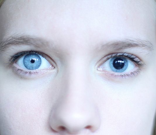 Cuando tus pupilas son asimétricas, la anisocoria