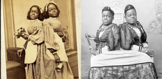 Millie y Christine McKoy, siamesas, esclavas, compradas y vendidas como objetos Millie y Christine McKoy, siamesas, esclavas, compradas y vendidas como objetos