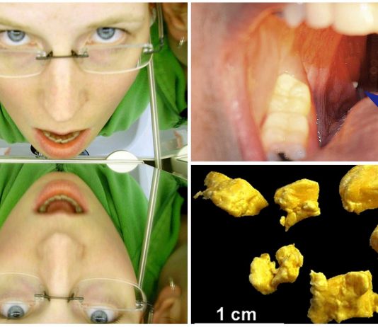 ¿Qué son esas bolitas blancas en tus amígdalas?