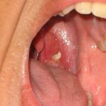 ¿Qué son esas bolitas blancas en tus amígdalas?