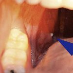 ¿Qué son esas bolitas blancas en tus amígdalas?