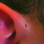 quiste preauricular