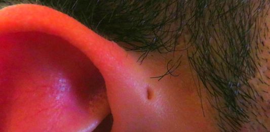 Algunos tienen un agujero de más en la oreja. ¿Qué es?