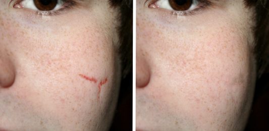 Cicatrizar sin cicatrices, ¡los científicos saben cómo conseguirlo!