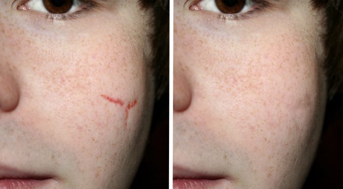 Cicatrizar sin cicatrices, ¡los científicos saben cómo conseguirlo!