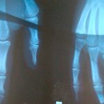 Radiografía, descubrimientos fortuitos sin los que hoy no podríamos vivir