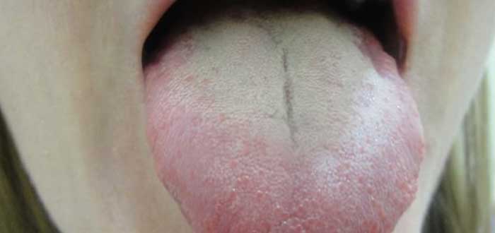¿Tienes la lengua blanca? Puede ser por varios motivos