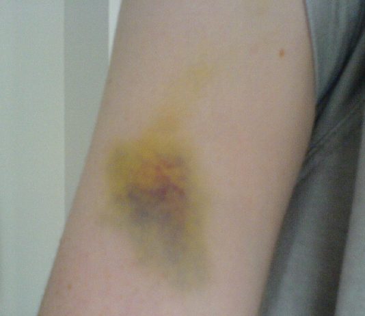 5 cosas que debes saber sobre los moretones 5 cosas que debes saber sobre los moretones