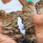 Epidermodisplasia Verruciforme – hombre árbol