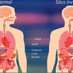 Situs inversus: un 0,01% de las personas tiene los órganos volteados 2