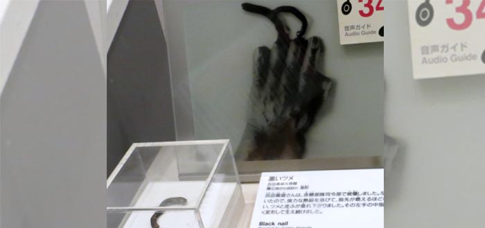 Una fotografía de las uñas negras que crecieron a uno de los supervivientes tras el ataque nuclear a Hiroshima - Museo Memorial de la Paz de Hiroshima