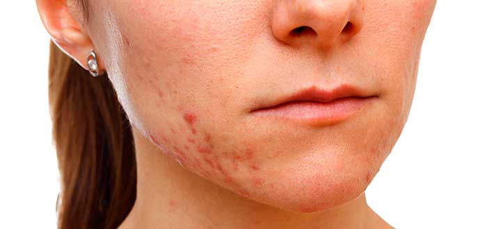 mitos del acné