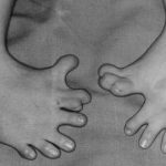 Extremidades inferiores de un bebé afectado por la Talidomida