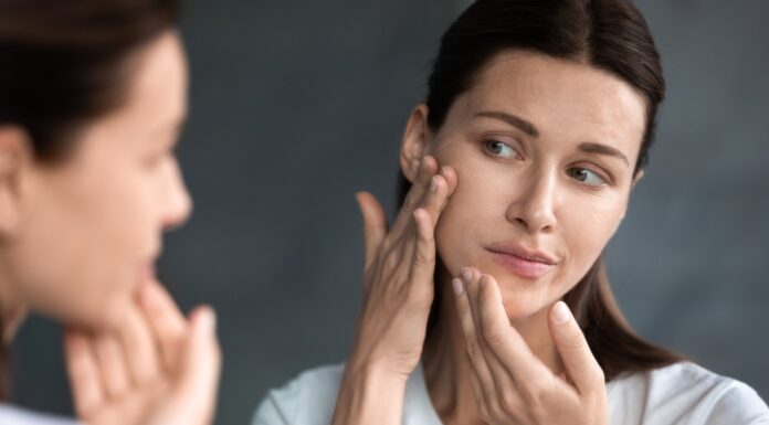 Mitos del acné