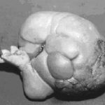 Fetus in fetu y gemelos parásitos ¿Ficción o realidad?