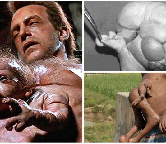 Fetus in fetu y gemelos parásitos ¿Ficción o realidad?