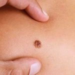 ¿Tienen alguna función los lunares de la piel? ¿Qué debes saber sobre ellos?