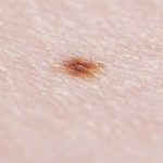 función de los lunares, melanocito