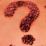 ¿Tienen alguna función los lunares de la piel? ¿Qué debes saber sobre ellos?