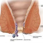 El fin de Napoleón en Waterloo fue por culpa de las hemorroides
