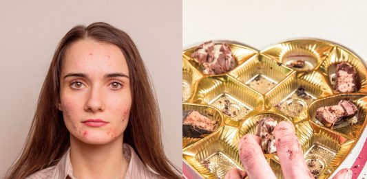 ¿Es cierto que el chocolate causa acné? Aquí tienes la respuesta