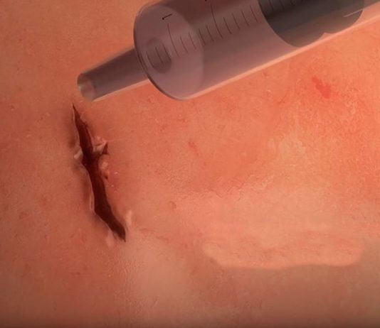 Pegamento quirúrgico, el futuro de la sutura Pegamento quirúrgico, el futuro de la sutura